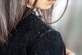 Woman hair having problem with dandruff on shoulder