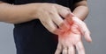 Closeup woman is scratching her hand with nails. Reddened, inflamed body parts causes discomfort and itching Royalty Free Stock Photo