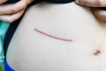 Closeup of woman showing on your stomach with a scar Royalty Free Stock Photo