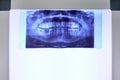 Closeup x-ray of human teeth Royalty Free Stock Photo