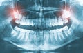 Closeup of x-ray image growing wisdom teeth pain concept. Royalty Free Stock Photo