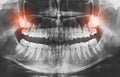 Closeup of x-ray image growing wisdom teeth pain concept. Royalty Free Stock Photo