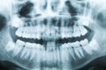 Closeup x-ray image of teeth and mouth Royalty Free Stock Photo