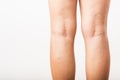 Woman painful varicose and spider veins on leg