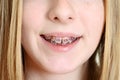 Closeup young girl with braces