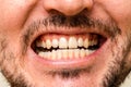 Closeup young man with beautiful smile. Teeth whitening, teeth straightening, fresh breath Royalty Free Stock Photo