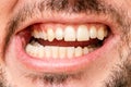 Closeup young man with beautiful smile. Teeth whitening, teeth straightening, fresh breath Royalty Free Stock Photo