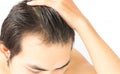 Closeup young man serious hair loss problem for health care sham Royalty Free Stock Photo