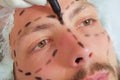 Closeup young mans face preparing for cosmetic surgery, getting lines drawn on skin with black marker, as seen from Royalty Free Stock Photo