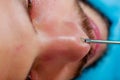 Closeup young mans face preparing for facial cosmetic treatment, doctor using metal tool with loop at end to measure Royalty Free Stock Photo