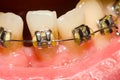 Closing of gap with dental braces Royalty Free Stock Photo