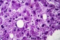 Cloudy swelling of the liver, light micrograph Royalty Free Stock Photo