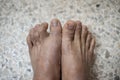 Foot of pateint skin dermatitis