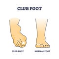 Club foot or talipes for baby that feet turn in and under outline diagram