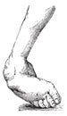 Clubfoot associated with equine varus, vintage engraving