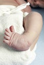 Clubfoot closeup of a newborn Royalty Free Stock Photo