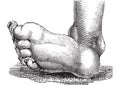 Clubfoot or congenital talipes equinovarus, vintage engraving