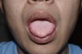 Coated tongue or white tongue. Loss of taste called ageusia