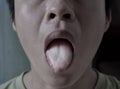 Coated tongue or white tongue. Loss of taste called ageusia