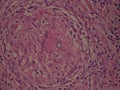 Coccidioides imitis spherule at center of granuloma on H and E stain