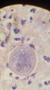 Coccidioides imitis spherule in skin biopsy specimen