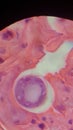 Coccidioides imitis spherule in skin biopsy specimen