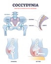 Coccydynia as pain felt in coccyx or tailbone anatomical outline diagram Royalty Free Stock Photo