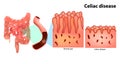 Coeliac disease or celiac disease