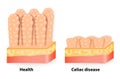 Coeliac disease or celiac disease