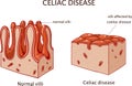 Coeliac disease or celiac disease. small bowel showing coeliac d Royalty Free Stock Photo