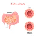 Coeliac disease. Cross section of small bowel with normal villi and villi affected by celiac disease Royalty Free Stock Photo