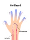 Cold hand blood circulation illustration sensitivity to cold, cold fingertips