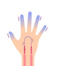 Cold hand blood circulation illustration sensitivity to cold, cold fingertips