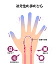 Cold hand blood circulation illustration sensitivity to cold, cold fingertips