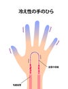 Cold hand blood circulation illustration sensitivity to cold, cold fingertips