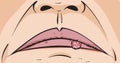 Cold Sore Royalty Free Stock Photo