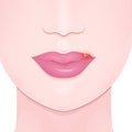 Cold sore lip