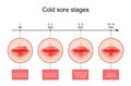 Cold sore stages. Lips with symptoms of Herpes labialis