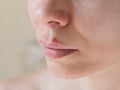 Cold sores. Close-up of the female face. Royalty Free Stock Photo