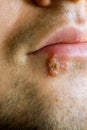 Cold sores (herpes labialis) Royalty Free Stock Photo