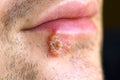 Cold sores (herpes labialis) Royalty Free Stock Photo