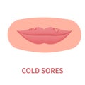 Cold sores outbreak of herpes HSV on lips