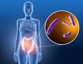 Colitis, bacterium clostridium difficile in large intestine, scientific 3D illustration