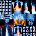 Collage of human X-rays photo