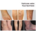 Collage from images of varicose veins