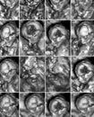 Collage of 16 medical images of 3D ultrasound anomaly scan on a
