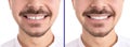 Collage with photos of man with diastema between upper front teeth before and after treatment on white background, closeup. Banner