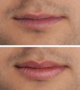 Collage with photos of man before and after lips augmentation, closeup