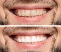 Collage with photos of man before and after teeth whitening, closeup Royalty Free Stock Photo