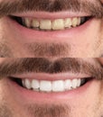 Collage with photos of man before and after teeth whitening, closeup Royalty Free Stock Photo